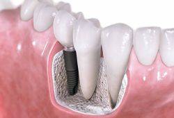Технология имплантации зубов