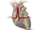 Лечение пролапса сердечного клапана
