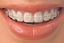 Способы исправления неправильной формы зубов