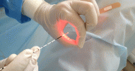 Лазер в медицинской практике: прижигание сердца