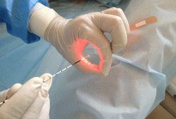 Лазер в медицинской практике: прижигание сердца