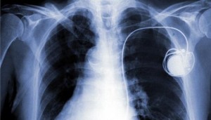 Сердце с электрокардиостимулятором (ЭКС)
