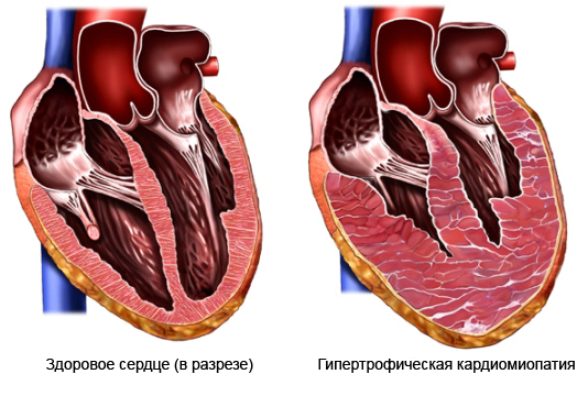 Гипертрофия сердца