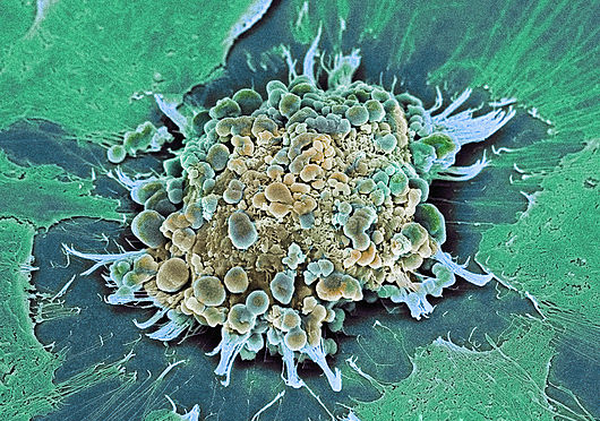 Вирусные заболевания способны разрушить раковую клетку